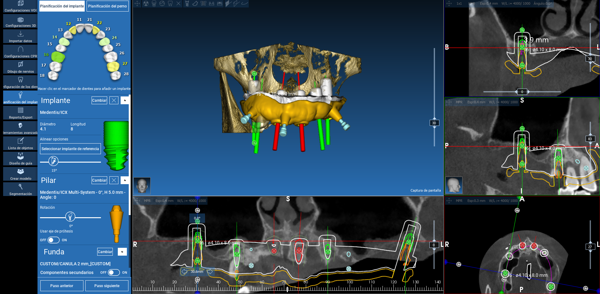 Cirug A Guiada En Implantes Dentales Un Camino Hacia Una Recuperaci N