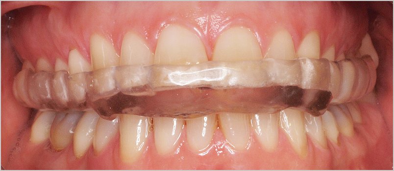 Bruxismo: ¿cómo afecta a los dientes y qué solución tiene? - Doctor Toledo
