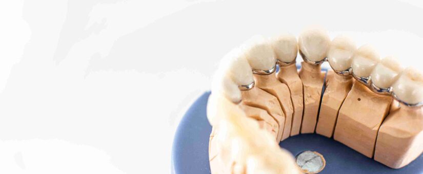 ¿Cómo es el proceso de colocación de un implante dental?